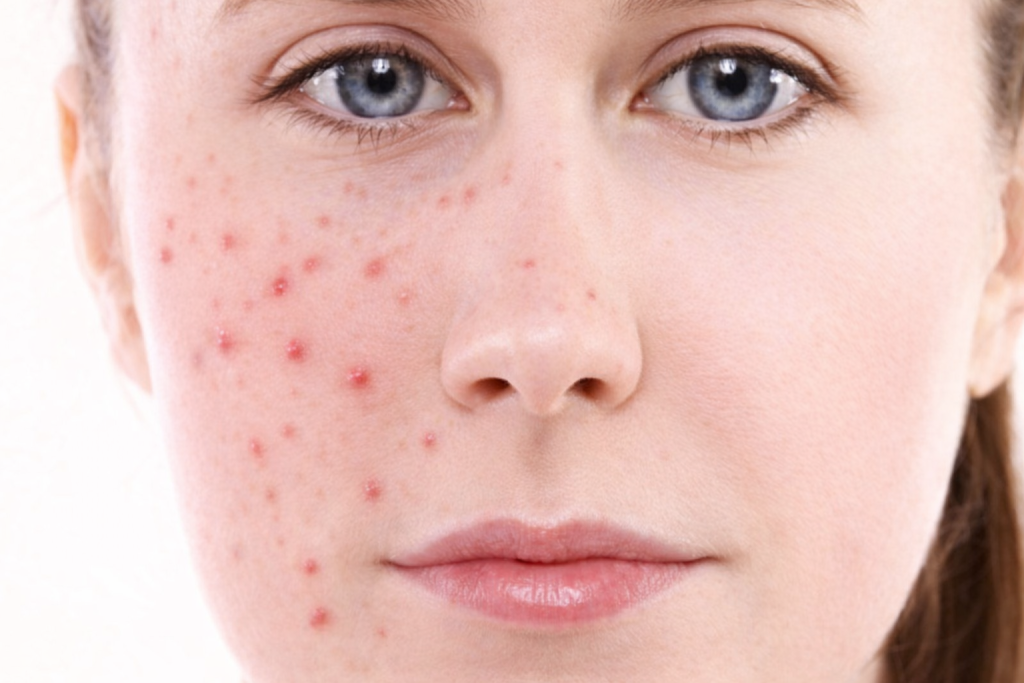 Small Red Pimples on Face