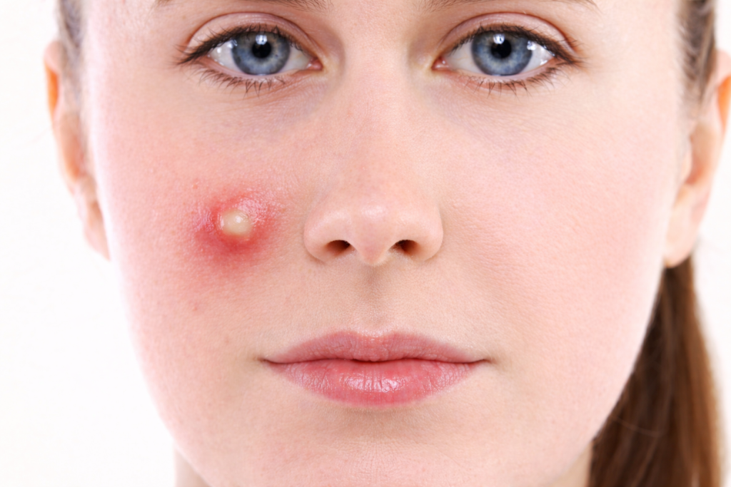 Blood Pimple on Face