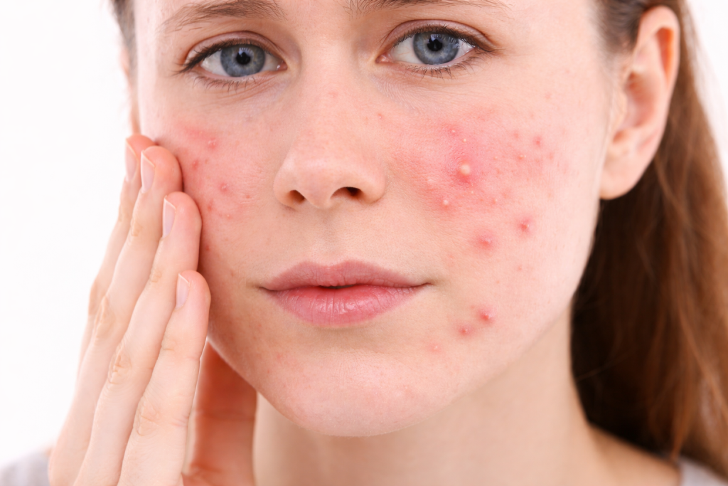 Stress Pimples on Face
