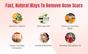 Natural Remedies for Pimples and Scars