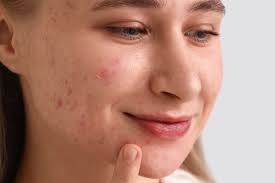 Pimples and Dark Marks on Face: Complete Solution