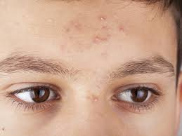 Special Cases of Pimples