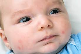 Pimples on Baby Face