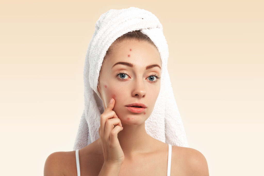 Lifestyle Changes That Naturally Prevent Pimples
